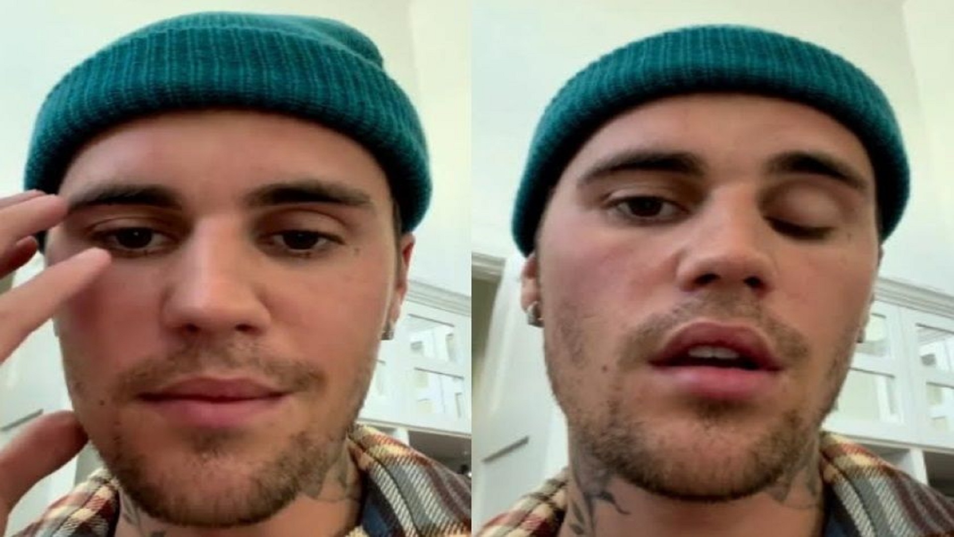 Apa itu sindrom Ramsay Hunt?